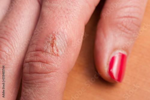 Detail of the infected burn on a woman's finger with red nail polish