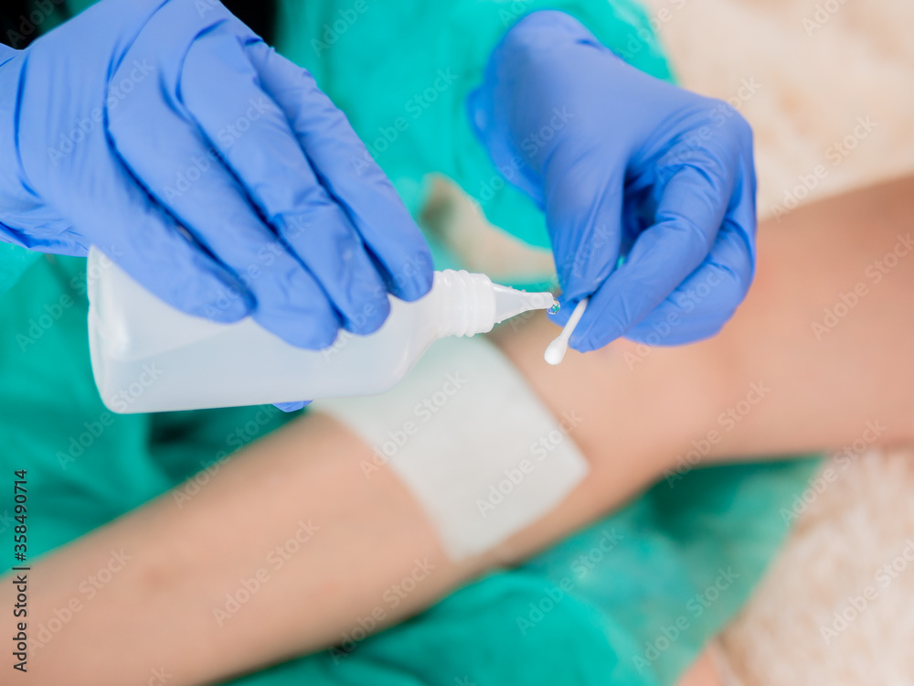 A doctor in sterile blue gloves processes a cotton swab with hydrogen peroxide to disinfect a wound on the patient's knee in the background. A doctor in sterile blue gloves processes a cotton swab with hydrogen peroxide to disinfect a wound on the patient's knee in the background.