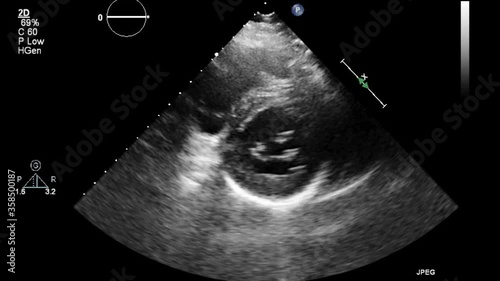 Transesophageal ultrasound video in gray-scale mode. photo