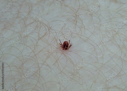 a tick stuck into the skin of a person leg on a walk across the field