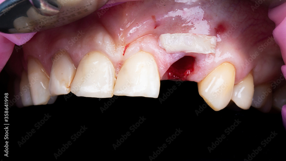 adding soft tissue to the mucous gums to increase volume and aesthetics after implantation