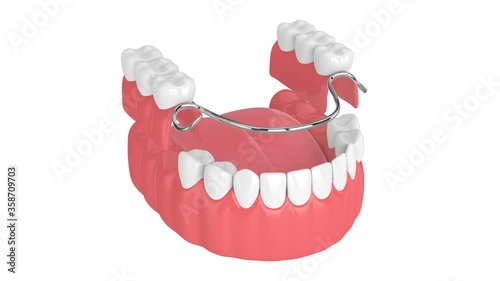 Removable partial denture isolated over white background
