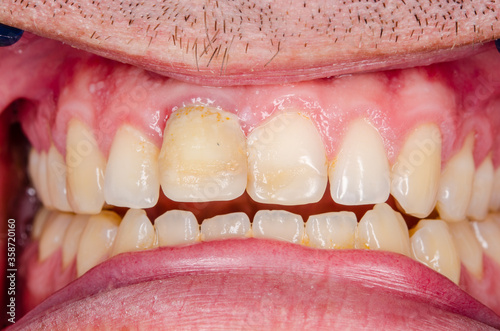 close up of a dental treatment