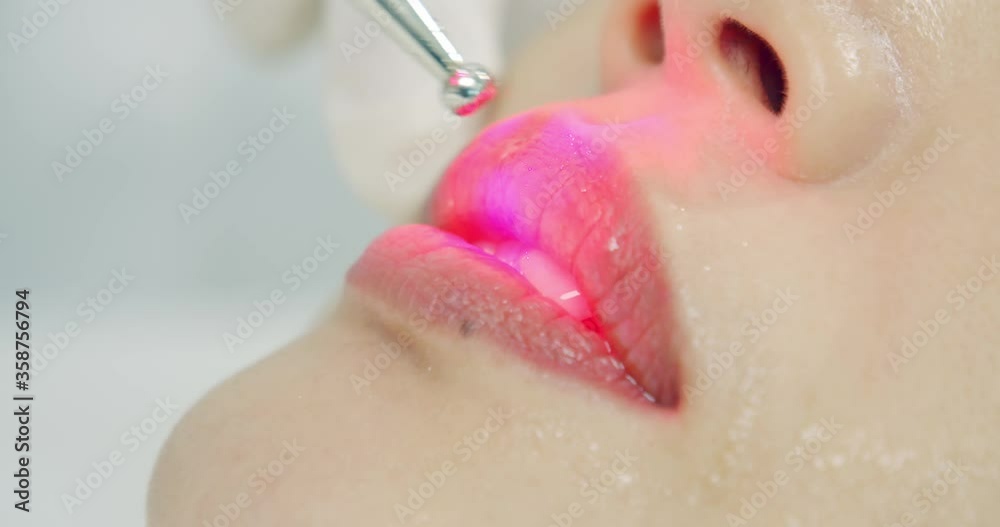 a close up shot of lip-free lip augmentation with innovative technic 