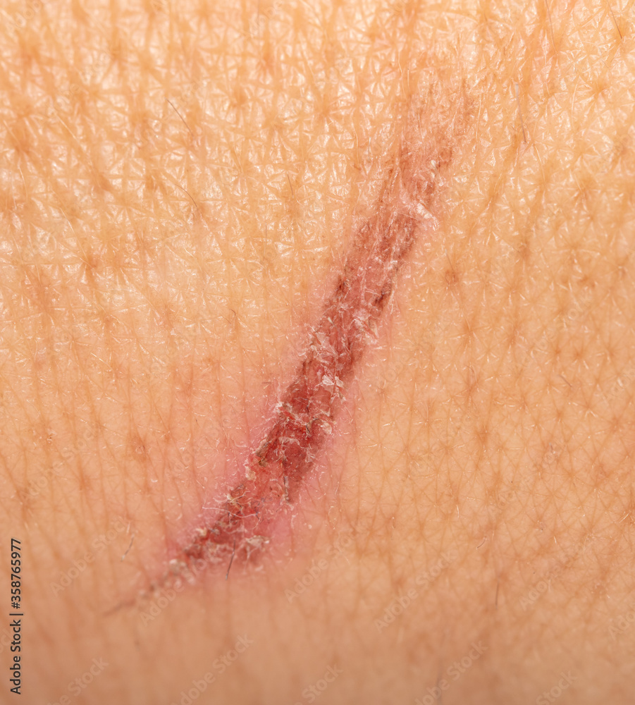 Fototapeta premium A wound on the skin of a person.
