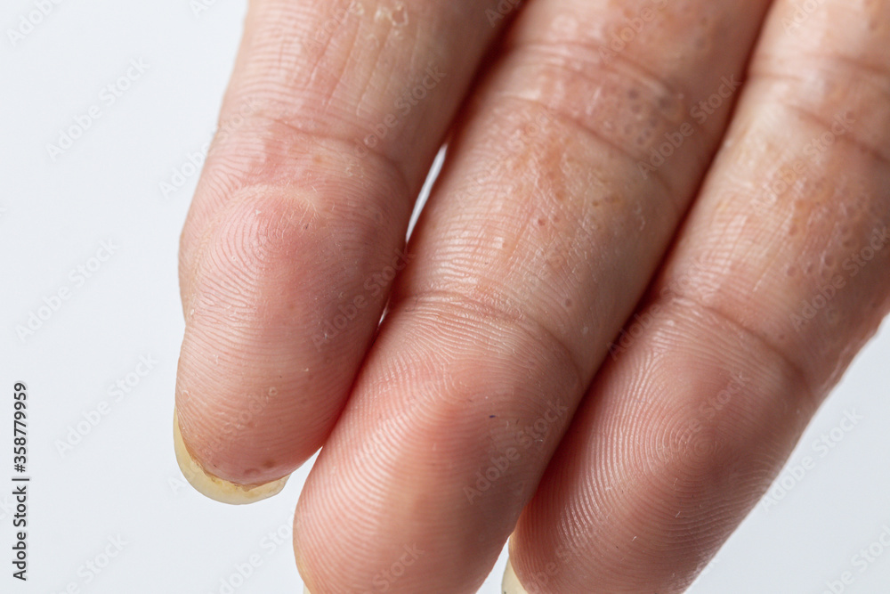 Close up Atopic dermatitis on finger(AD), also known as Atopic eczema.Skin disease concept. Close up Atopic dermatitis on finger(AD), also known as Atopic eczema.Skin disease concept.