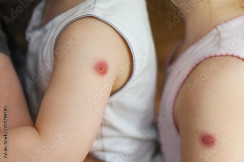 Картината върху платно Kids with a reaction to the BCG vaccine on the forearm