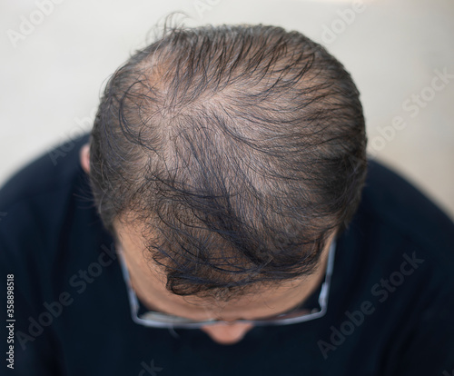 Hair loss top view of asia man