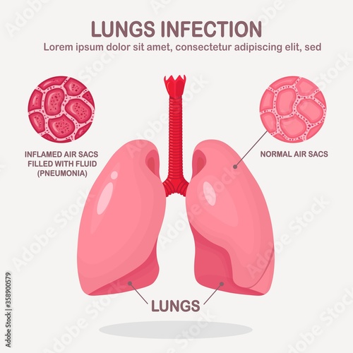 Lungs with respiratory infection isolated on white background. Pneumonia, tuberculosis, cancer concept. Normal and inflamed air sacs filled with fluid. Vector cartoon design 