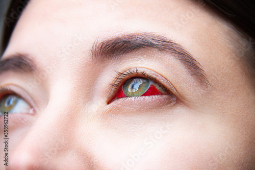 Closeup of female green eye stained with red blood. Сonsequences of surgery, intravitreal administration of medicinal product. Treatment of macular degeneration. Violence concept. Vision diseases. photo