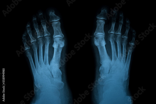 Film X-ray of Rheumatoid arthritis leg shows joint space narrowing of the legs. Rheumatoid arthritis patient's legs in x-ray. Medical and healthcare shot. Radiology concept.