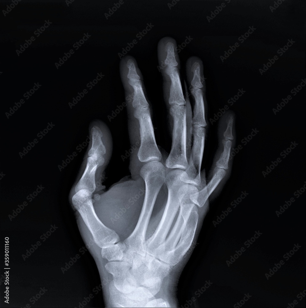 radiography of the hand bones without pathology radiography of the hand bones without pathology