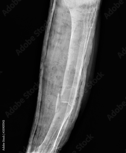 radiograph of the lower leg with a pathological fracture of the tibia