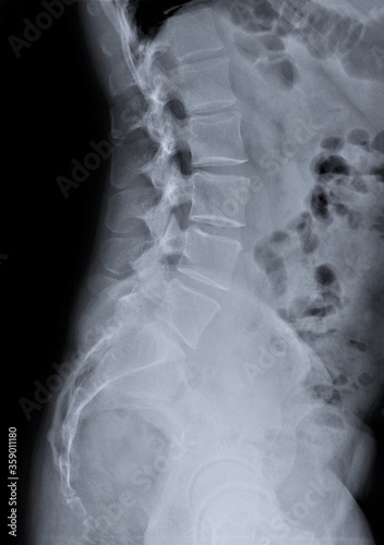 x-ray of the lumbar spine of an adult in a lateral projection