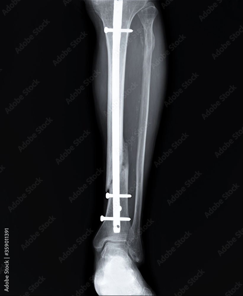 radiography with an unconsolidated fracture of the tibia of the fixed iron core radiography with an unconsolidated fracture of the tibia of the fixed iron core