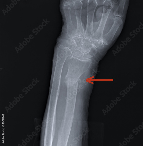 radius fracture on the x-ray of the forearm