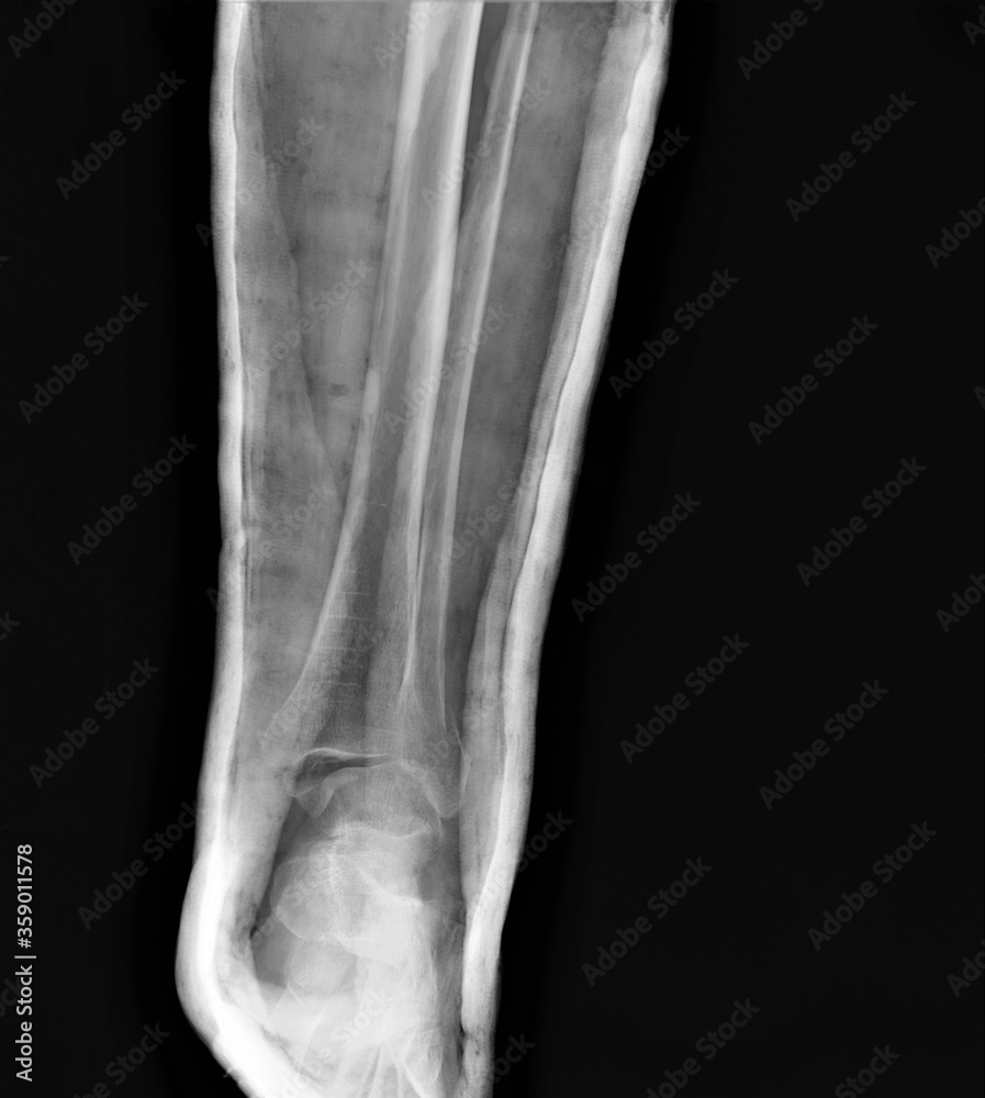 x-ray of a broken ankle in a cast x-ray of a broken ankle in a cast