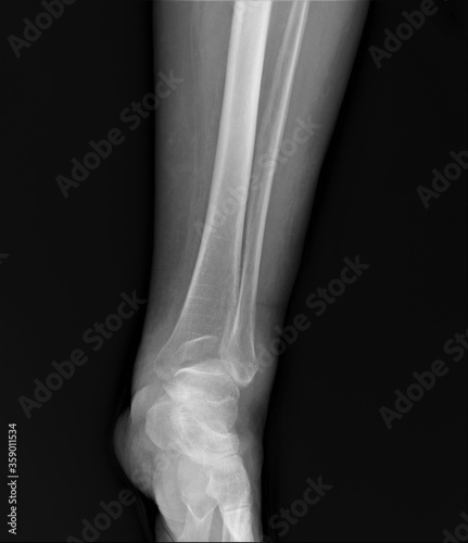 x-ray of an ankle with