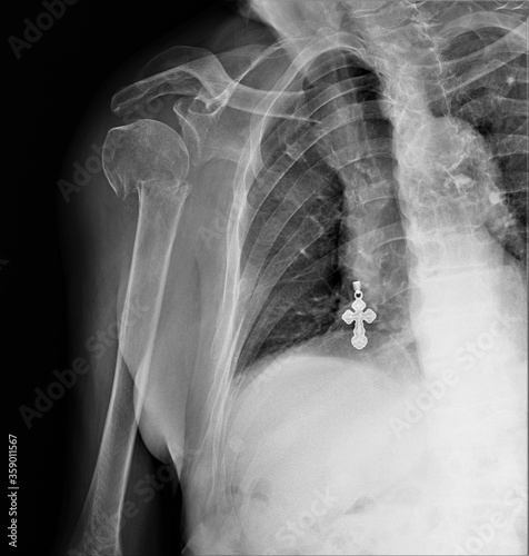 radiography of the shoulder joint with a fracture of the surgical neck of the humerus with dislocation of fragments