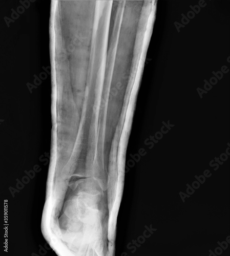 x-ray of a broken ankle in a cast