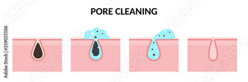 Vector illustration of skin care. Steps of pore cleaning. Washing stages on clogged face. Sebum removal, pores cleaning and narrowing with washing gel. Concept of skin treatment