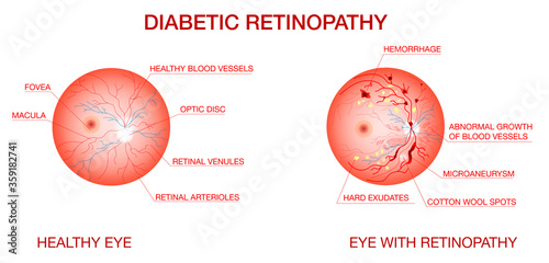 Anatomy of normal eye and Diabetic retinopathy.Diagram of the eye.