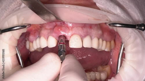 surgeon removes the dental implant with special equipment due to complications of inflammation in the gum cavity