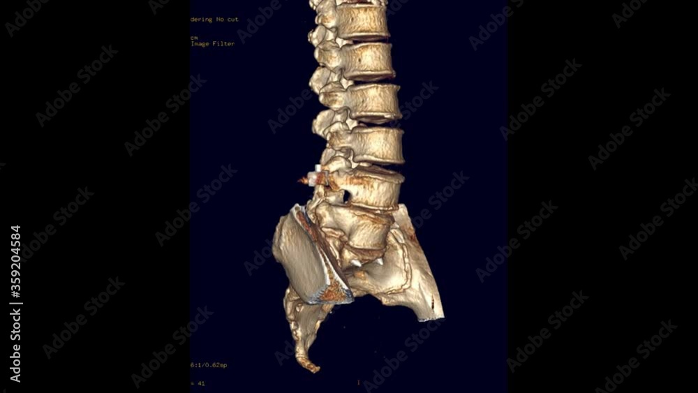 CT Lumbar spine or L-S spine 3D rendering image turn around on the ...