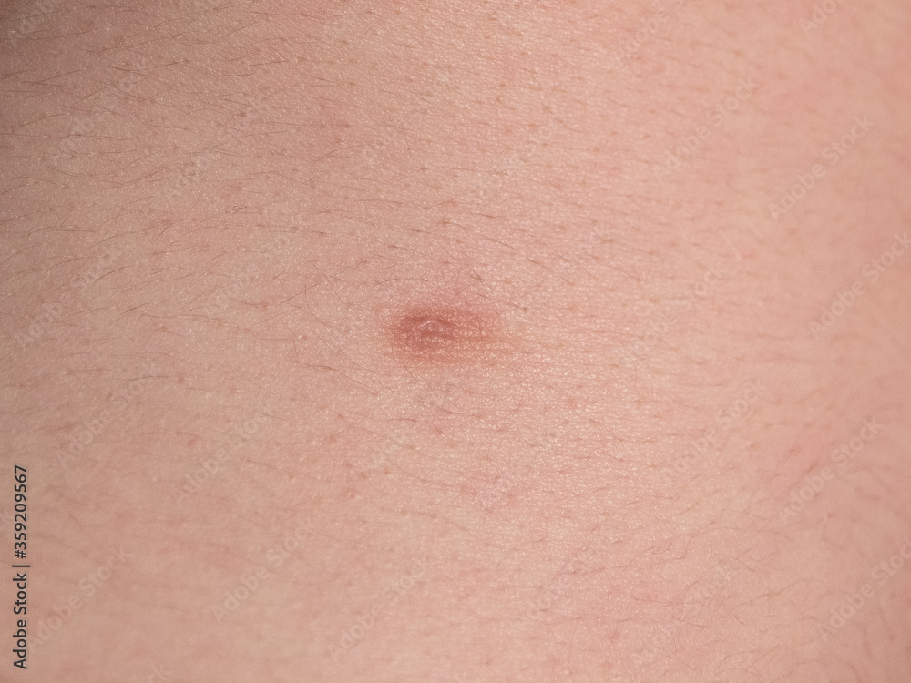Picture of a male torso with a third nipple - Close-up (supernumerary nipple)