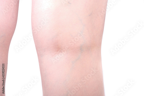 Varicose veins on the back of the knee.