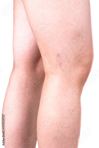 Varicose veins on the side of the knee joint.