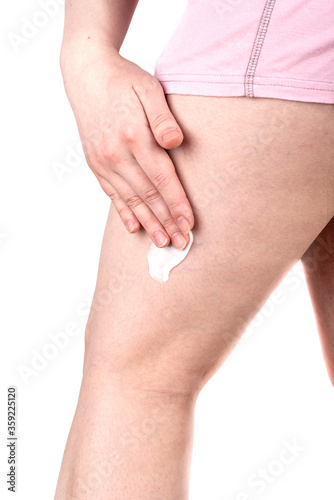 Woman lubricates with cream the places of varicose veins on the leg.