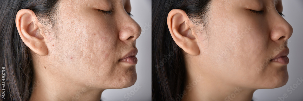 Skin problems and acne scar, Before and after acne facial care treatment, Beauty concept.