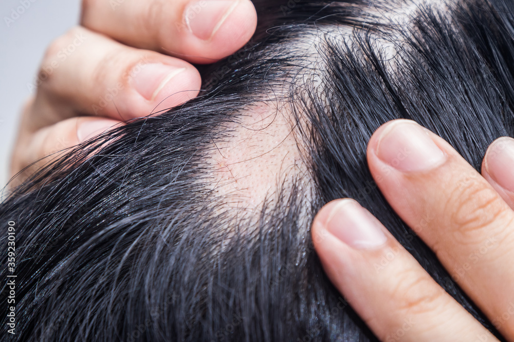 Obraz premium Alopecia Areata - Spot Baldness is a condition in which hair is lost from some or all areas of the body.