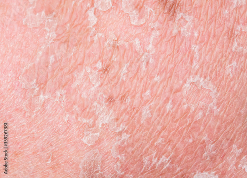 texture of irritated pigmented skin covered with cracks and scales after sunburn