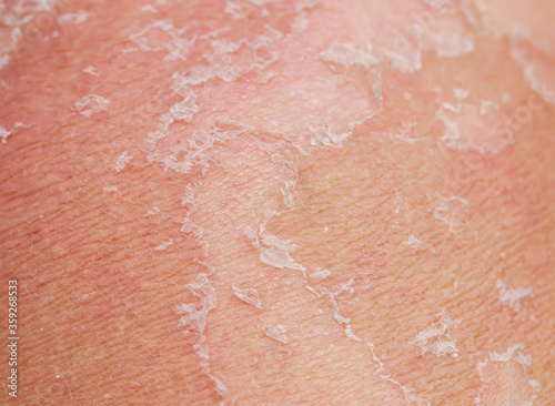 texture of irritated skin with scales of dead cells and redness after sunburn and allergies leave the body