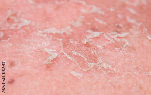  texture of irritated reddened skin with flaking scales of dead old cells after sunburn and allergies on the human
