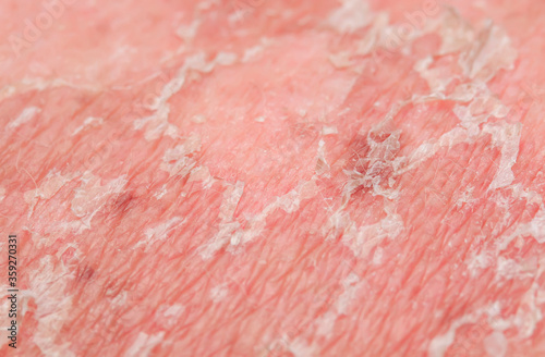 texture of irritated reddened skin with flaking scales of dead old cells after sunburn and allergies on the human