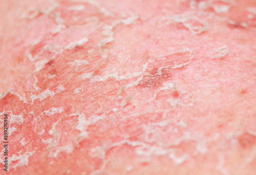 texture of irritated reddened skin with flaking scales and cracks from sunburn and allergies on the human body