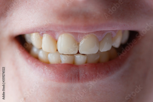 Woman's mouth with white teeth.