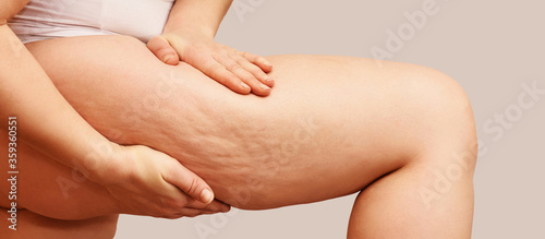 Cellulite leg woman pinch. Test fat hips treatment. Over weight liposuction. Remove striae. photo