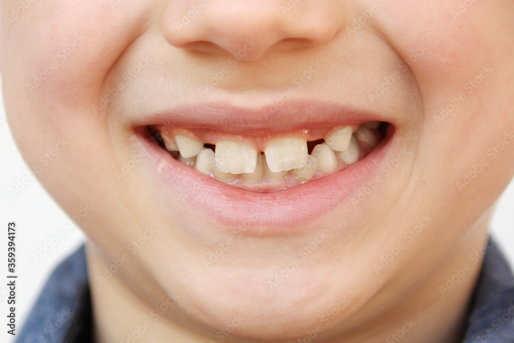 boy, kid smiling with open mouth, close-up of a child’s mouth, concept of child skin care, emotional development of elementary school students, dentistry boy, kid smiling with open mouth, close-up of a child’s mouth, concept of child skin care, emotional development of elementary school students, dentistry