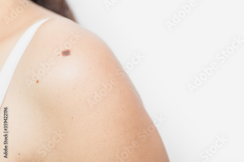 Close up a large mole on the left arm of Asian young woman

