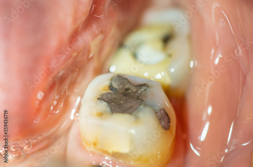 Canvas Print Filling in back tooth closeup macro view