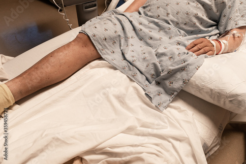Torso and leg of an amputee man in a hospital bed, sick, disabled veteran, copy space, horizontal aspect