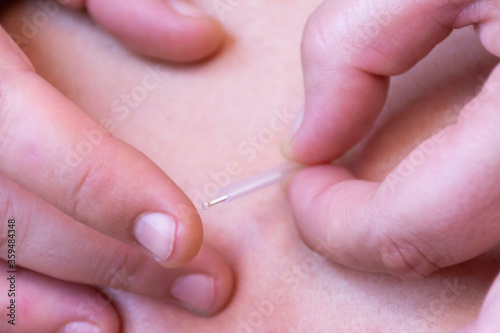 Nailing an acupuncture needle