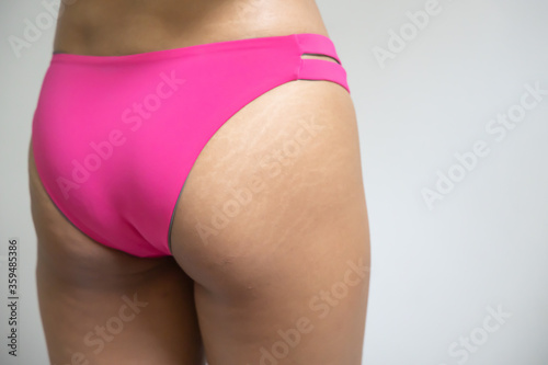 woman hip with stretch mark and cellulite, concept of beauty skin care