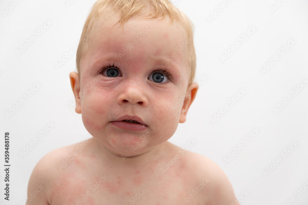 Close up portrait of toddler with swollen eye. severe allergic reaction  Stock Photo | Adobe Stock