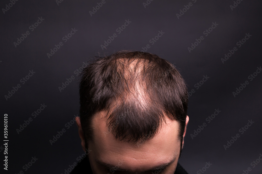 Fototapeta premium Male head close-up with baldness. Studio black background.
