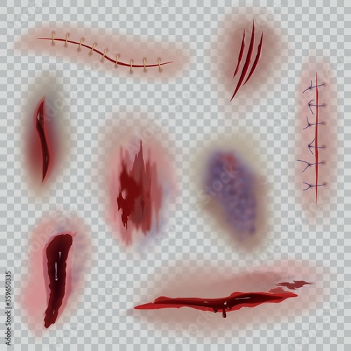 Realistic wounds. Scars, surgical stitches and bruise, skin incision. Bloody wound halloween close-up textures vector isolated set photo